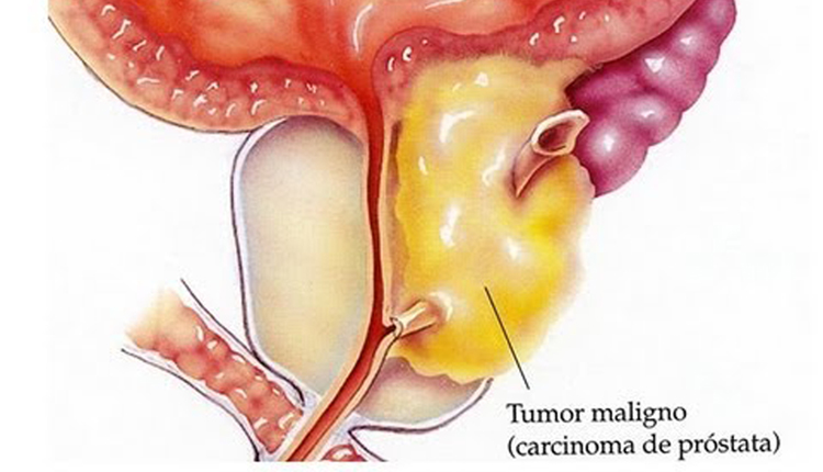 Tumor maligno Imagem: divulgação