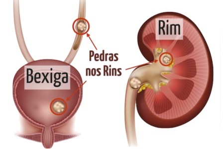 Pedra nos Rins
