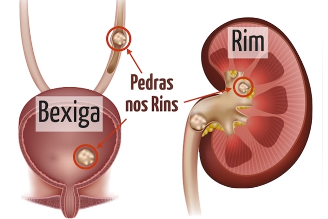 Pedra nos Rins