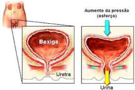 Tratamento da cistite intersticial
