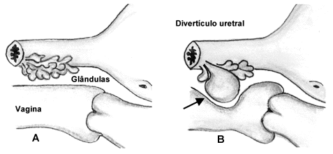 diverticulo de uretra feminino