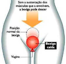 Prolapso de bexiga