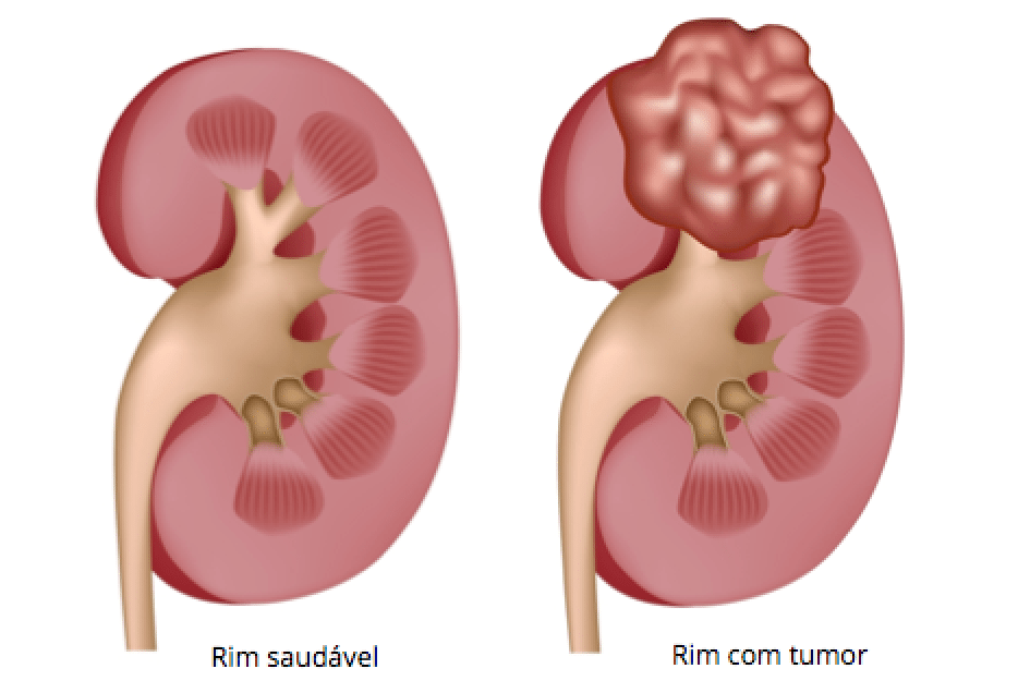 cancer de rim