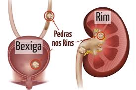 Pedra na bexiga