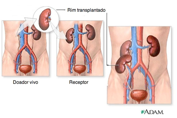 Transplante Renal - fonte SBN (Sociedade Brasileira de Nefrologia)