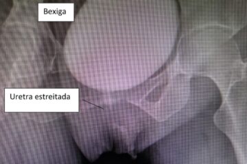 estenose de uretra