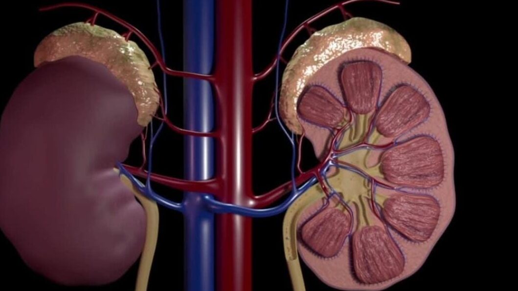 Cirurgia de Cálculo Renal